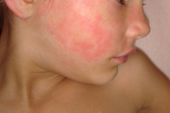 Close-up of a rash on the face of an 8-year-old girl with slapped cheek disease.